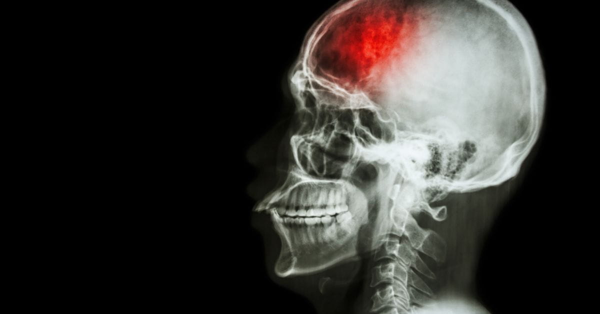 Stroke - North Bengal Neuro Centre Blog