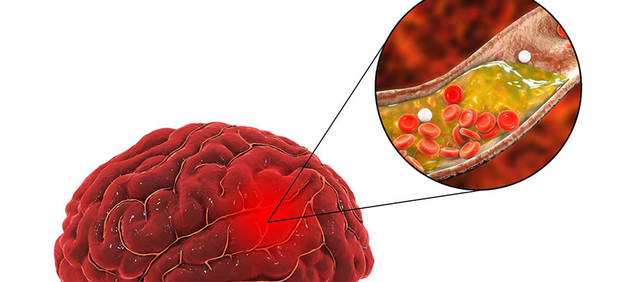 Cerebrovascular Diseases and Stroke