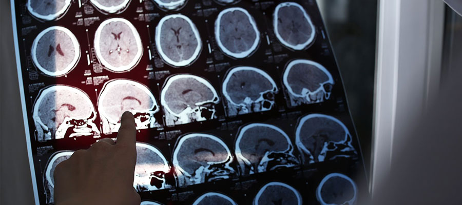 Cerebrovascular Diseases and Stroke