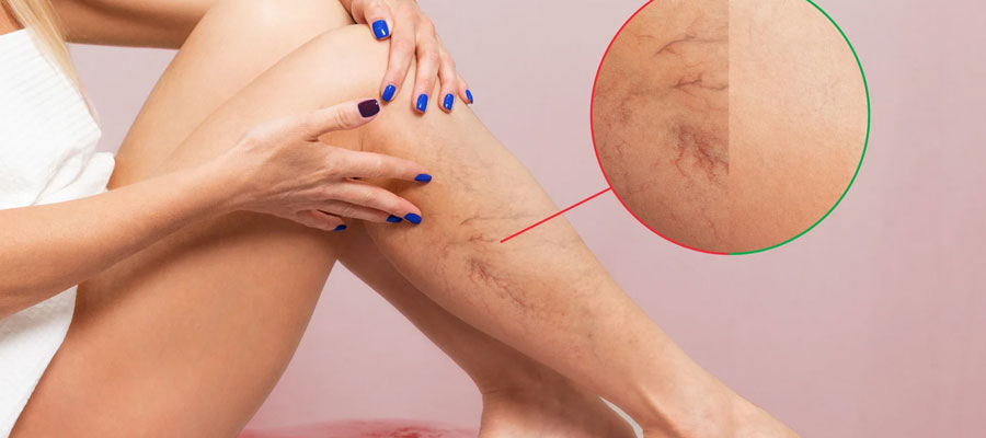 Varicose vein treatment in Siliguri